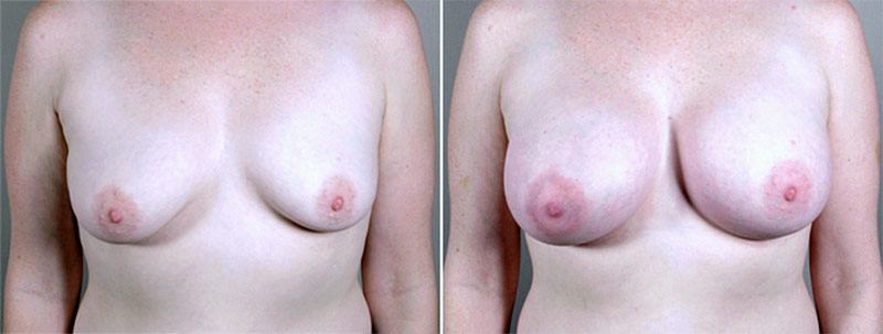 Breast Enlargement (Augmentation) Patient 30