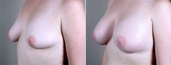 Breast Enlargement (Augmentation) Patient 30