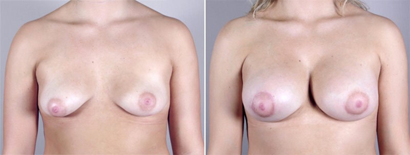 Breast Enlargement (Augmentation) Patient 31