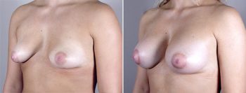 Breast Enlargement (Augmentation) Patient 31