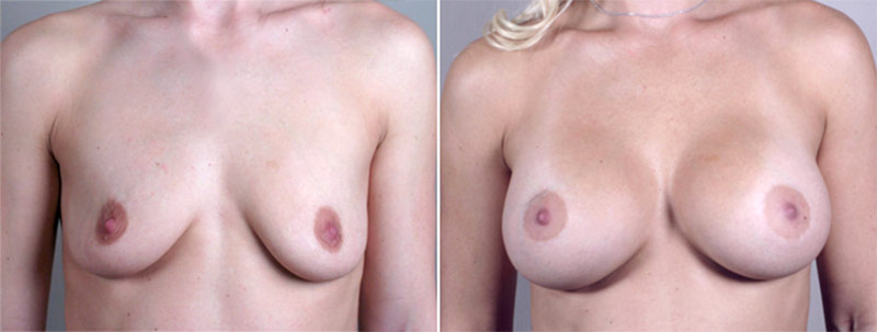 Breast Enlargement (Augmentation) Patient 33