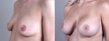 Breast Enlargement (Augmentation) Patient 33