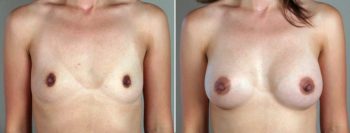 Breast Enlargement (Augmentation) Patient 1