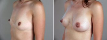 Breast Enlargement (Augmentation) Patient 1