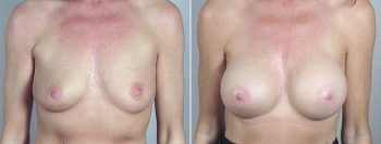Breast Enlargement (Augmentation) Patient 34