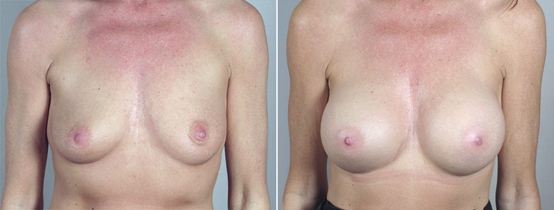 Breast Enlargement (Augmentation) Patient 34