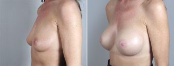 Breast Enlargement (Augmentation) Patient 34