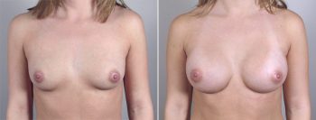 Breast Enlargement (Augmentation) Patient 14