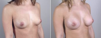 Breast Enlargement (Augmentation) Patient 14
