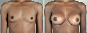 Breast Enlargement (Augmentation) Patient 4