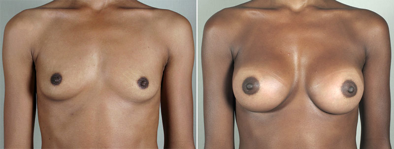Breast Enlargement (Augmentation) Patient 4