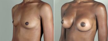 Breast Enlargement (Augmentation) Patient 4