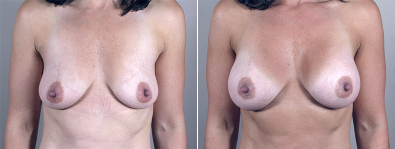 Breast Enlargement (Augmentation) Patient 3