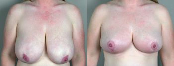 Liposuction Patient 13