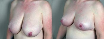Liposuction Patient 13