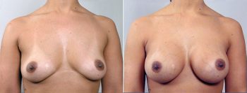 Breast Enlargement (Augmentation) Patient 5