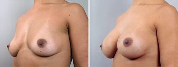 Breast Enlargement (Augmentation) Patient 5