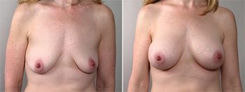 Breast Enlargement (Augmentation) Patient 37