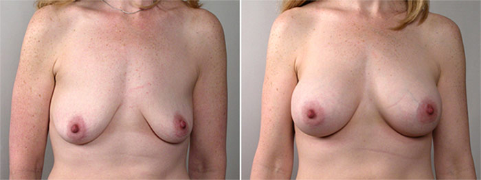 Breast Enlargement (Augmentation) Patient 37