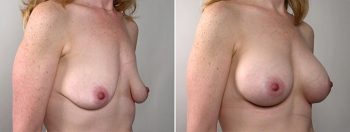 Breast Enlargement (Augmentation) Patient 37