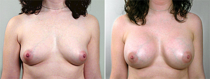 Breast Enlargement (Augmentation) Patient 38