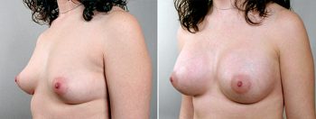 Breast Enlargement (Augmentation) Patient 38