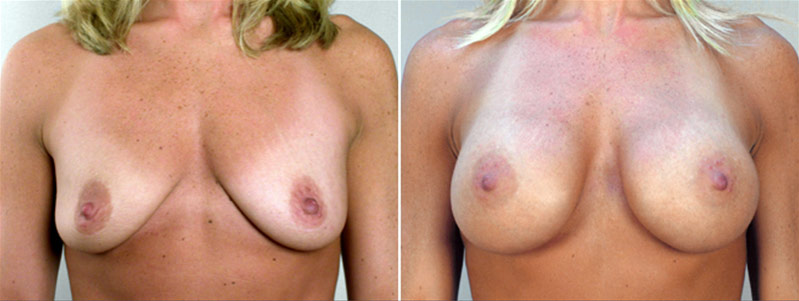 Breast Enlargement (Augmentation) Patient 6