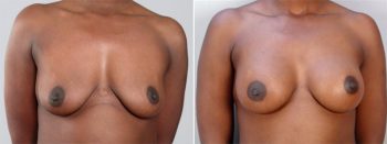 Breast Enlargement (Augmentation) Patient 7