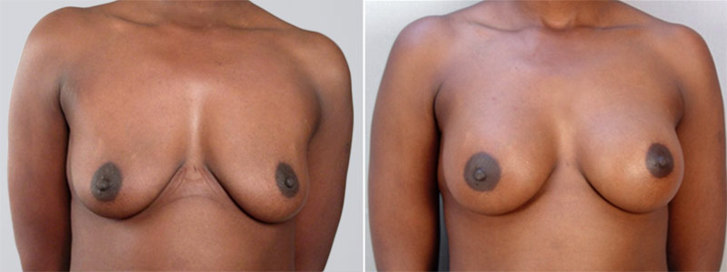 Breast Enlargement (Augmentation) Patient 7