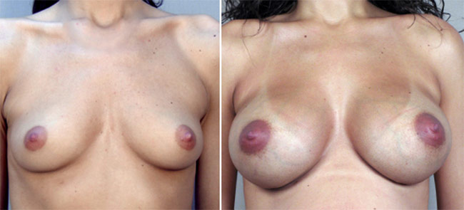 Breast Enlargement (Augmentation) Patient 8