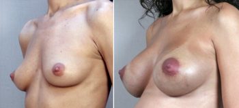Breast Enlargement (Augmentation) Patient 8