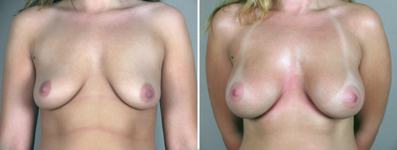 Breast Enlargement (Augmentation) Patient 9