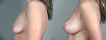 Breast Enlargement (Augmentation) Patient 9