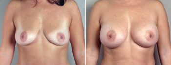 Breast Enlargement (Augmentation) Patient 10