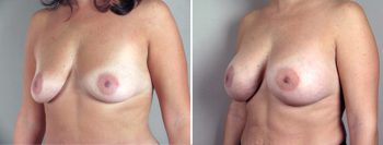 Breast Enlargement (Augmentation) Patient 10