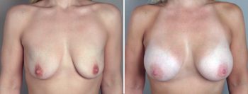 Breast Enlargement (Augmentation) Patient 11