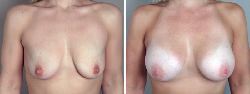 Breast Enlargement (Augmentation) Patient 11