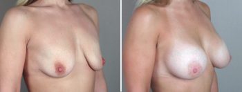 Breast Enlargement (Augmentation) Patient 11