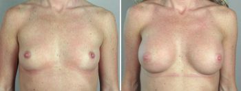 Breast Enlargement (Augmentation) Patient 12