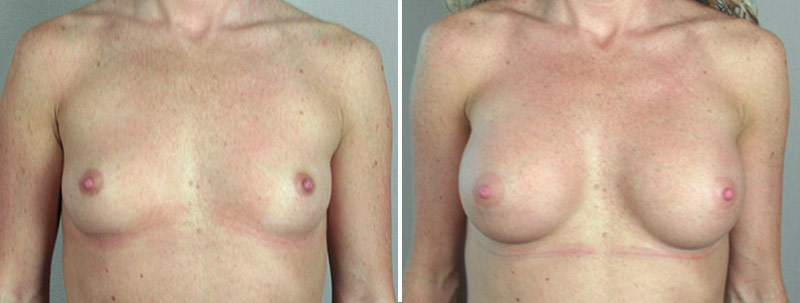 Breast Enlargement (Augmentation) Patient 12