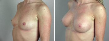 Breast Enlargement (Augmentation) Patient 12