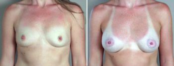 Breast Enlargement (Augmentation) Patient 13