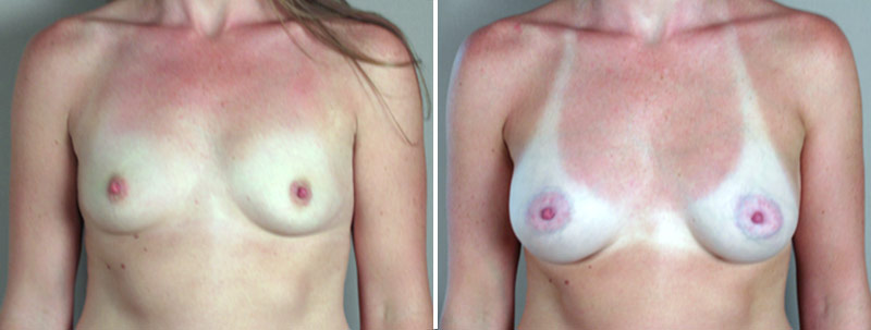 Breast Enlargement (Augmentation) Patient 13