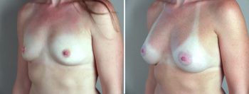 Breast Enlargement (Augmentation) Patient 13