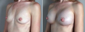 Breast Enlargement (Augmentation) Patient 36