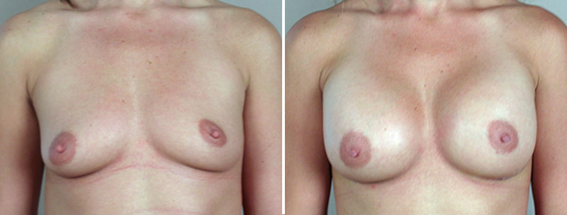 Breast Enlargement (Augmentation) Patient 35