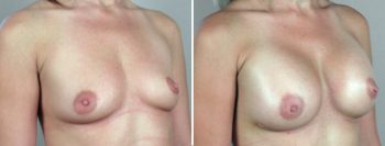 Breast Enlargement (Augmentation) Patient 35