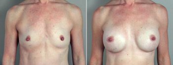 Breast Enlargement (Augmentation) Patient 18