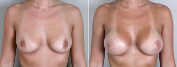 Breast Enlargement (Augmentation) Patient 2