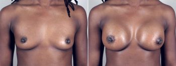 Breast Enlargement (Augmentation) Patient 22